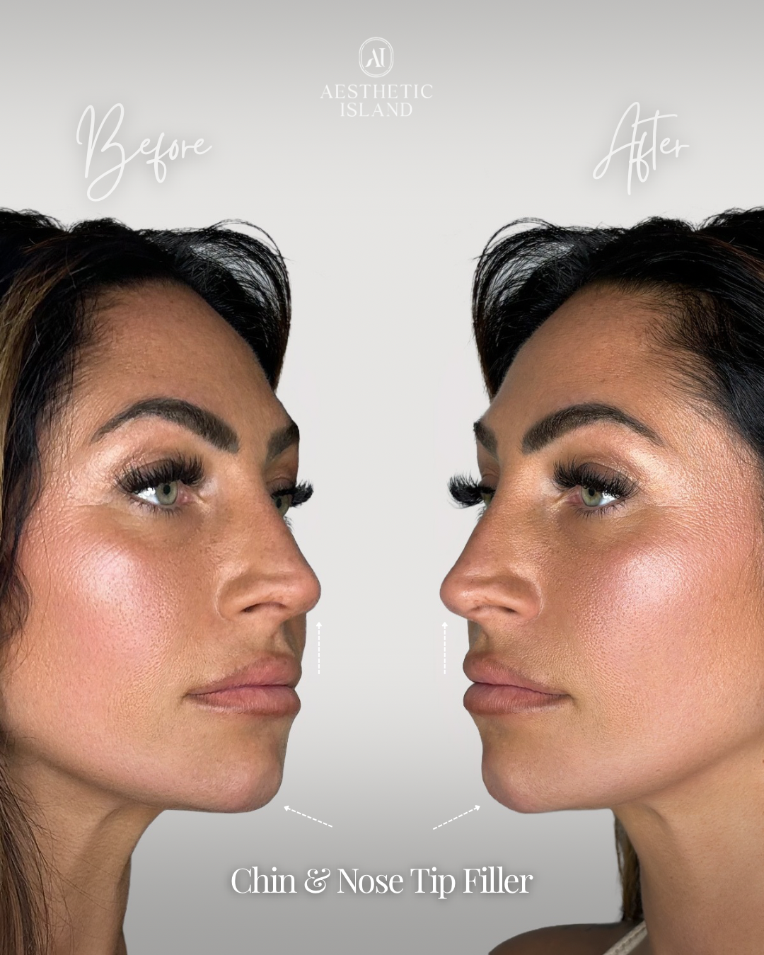 Chin & Nose Tip Filler before and after treatment result