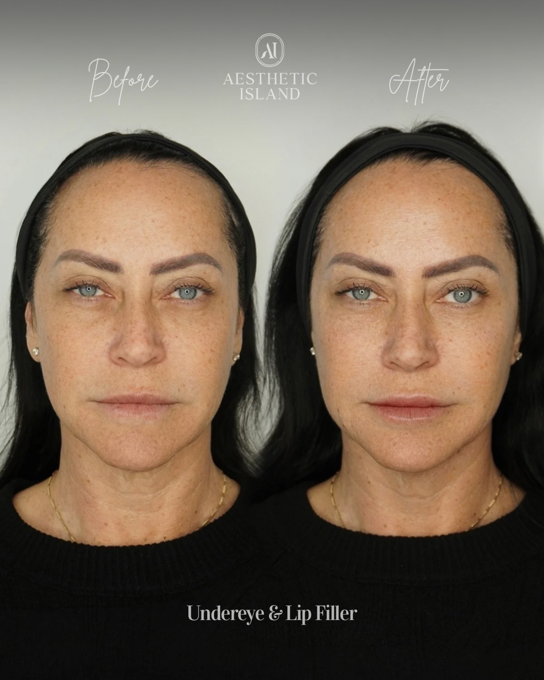 Undereye & Lip Filler before and after treatment result